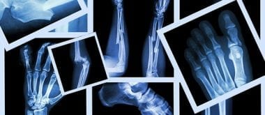 Überblick über Osteoporose-Frakturen bei Männern