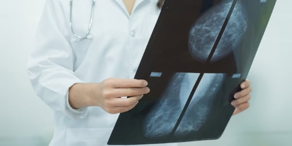 MRT besser als Mammogramme für dichtes Brustgewebe? 1