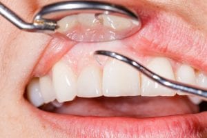 Der alternde Hormonhaushalt und seine Auswirkungen auf die Zahngesundheit 1