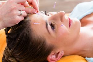 Linderung wechseljahrbedingter Migräne durch Akupunktur 1