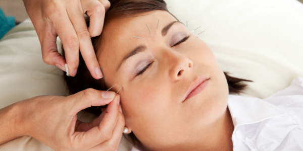 Linderung wechseljahrbedingter Migräne durch Akupunktur