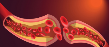 Die Länge des Menstruationszyklus in der Perimenopause kann Arteriosklerose vorhersagen