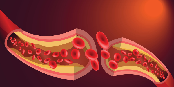 Die Länge des Menstruationszyklus in der Perimenopause kann Arteriosklerose vorhersagen