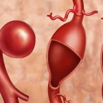 Arterielle Steifigkeit im Alter erhöht das Risiko für Herzerkrankungen