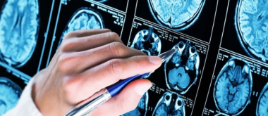 Wie Alzheimer und Sexualhormone zusammenhängen 1