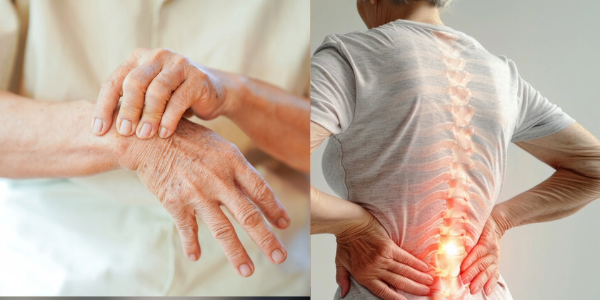 Zwei Schlüsselgene identifiziert, die rheumatoide Arthritis und Osteoporose verbinden