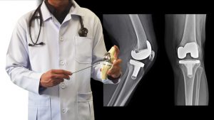 Der überraschende Grund, warum Röntgenaufnahmen Arthrose-Patienten zu einer Operation bewegen können 1