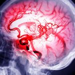 Wissenschaftler reparieren Schlaganfallschäden mit Stammzellen
