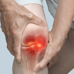 Neue Studie zeigt, dass rheumatoide Arthritis lange vor dem Auftreten von Symptomen beginnt