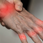 Eine traditionelle brasilianische Pflanze zeigt unerwartete Wirksamkeit gegen Arthritis 2