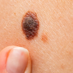 Schwarzer Hautkrebs: Die Behandlung von Melanomen mit niedriger Dosis liefert deutlich bessere Ergebnisse