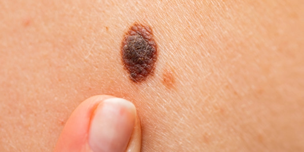 Schwarzer Hautkrebs: Die Behandlung von Melanomen mit niedriger Dosis liefert deutlich bessere Ergebnisse