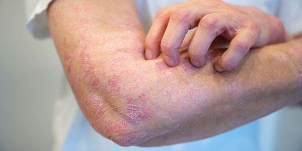 Wissenschaftler decken auf, warum Psoriasis zu einer Gelenkerkrankung führen kann