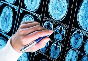 Wissenschaftler haben einen neuen Auslöser für Alzheimer und ein Medikament entdeckt, das dessen Fortschreiten stoppt 1