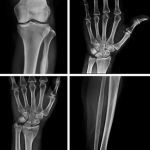 Neue Hoffnung für Knochen und Gelenke: Forscher entwickeln regenerative Therapien