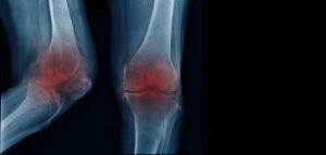 Neue Ultraschallmethode zeigt Potenzial zur Vorbeugung von Arthrose 1