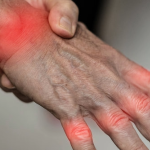 Verschmutzte Luft könnte rheumatoide Arthritis verschlimmern