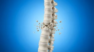 Ein Schalter für stärkere Knochen? Forscher entdecken einen neuen Ansatz gegen Osteoporose 1